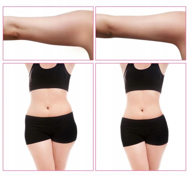 kawitacja-liposukcja-ultradzwiekowa-40k-rf-efekty-przed-po