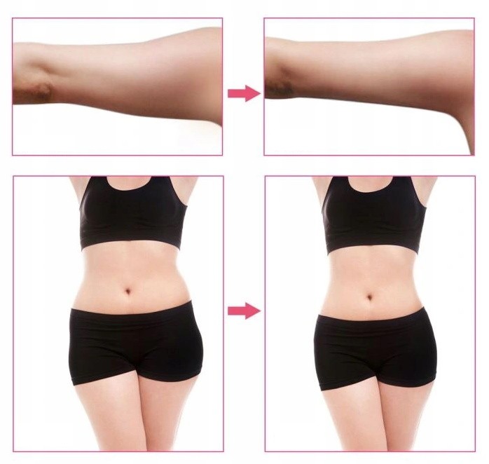 mini-rf-liposukcja-lifting-efekty-przed-po